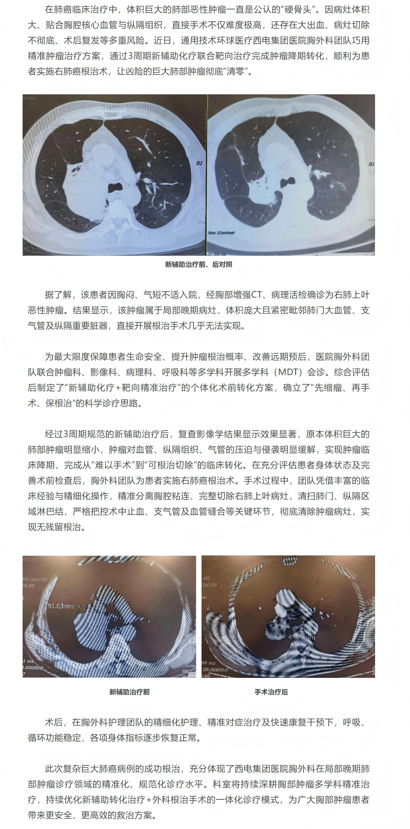 先“精准打压”再“连根拔除” ！西电集团医院胸外科分步闯关精准除瘤.png