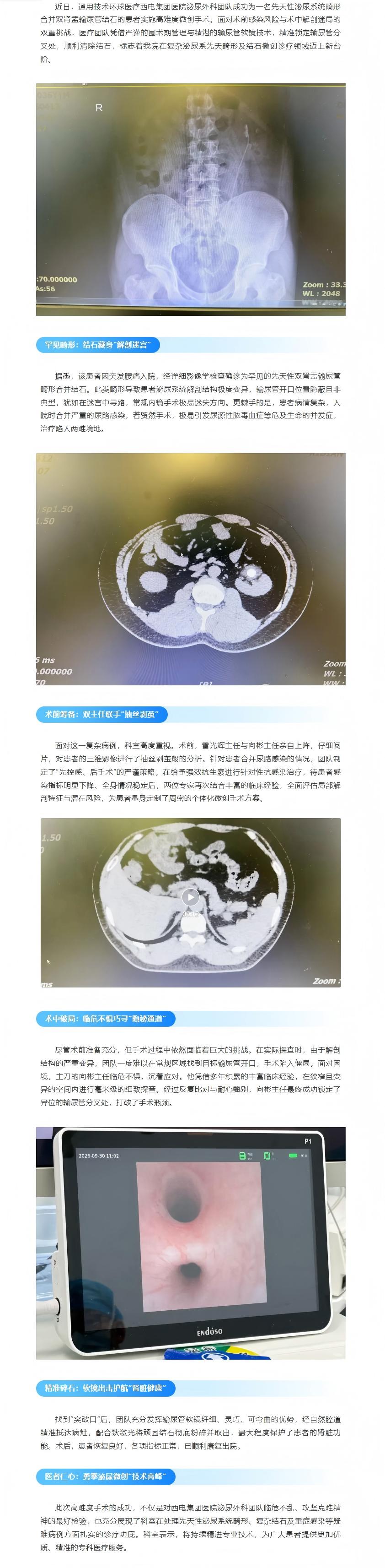 精准微创破迷局！西电集团医院泌尿外科成功为双肾盂输尿管畸形患者清除结石.jpg